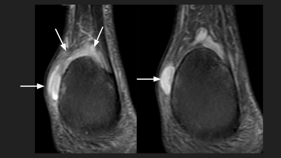 Figure 3 for case retrocalcaneal bursa ( RID3217 )